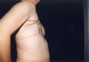 Breast Reconstruction 2c